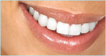 Odontoiatria estetica e sbiancamento